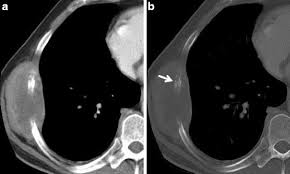 Check spelling or type a new query. Sarcomatoid Mesothelioma Axial View Contrast Enhanced Ct Scan Soft Download Scientific Diagram