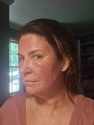 Laser recommendations for skin tightening?