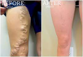 Pin On Varicose Veins
