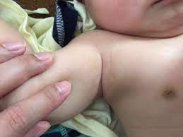 副乳は遺伝しやすい！赤ちゃんの脇に副乳を見つけた話 - 子育て記録あれやこれ