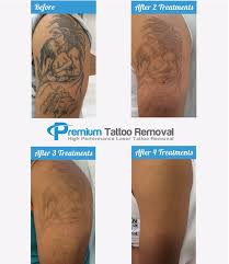 All natural tattoo removal methods — other options for removing tattoos at home include applying lemon juice, honey or a mixture of aloe vera, paederia tomentosa, and vitamin e. Premium Tattoo Removal After Four Laser Treatments This Tattoo Almost Vanished To Clear The Tattoo Completely We Performed One More Treatment Our Patient Couldn T Be Happier With The Result By Giving