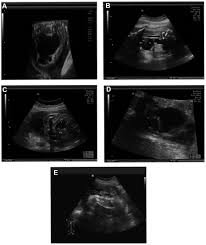 Prognostic Value Of Three Dimensional Ultrasound For Fetal Hydronephrosis