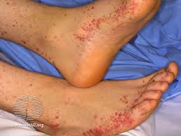 Image result for Vasculitis