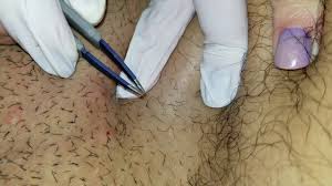 Ingrown hair near your vagina (really, your vulva, the skin around your vagina) is annoying. Ingrown Hair In Groin Area Youtube