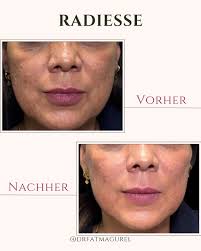 langfristiger Kollagenaufbau. Der Calciumhydroxylapatit-Filler strafft,  konturiert und regt die körpereigene Kollagenproduktion an. Ideal für  Kinnlinie, Wangen, Hals und Hände