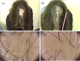 It stimulates new hair growth. Lichen Planopilaris And Low Level Light Therapy Four Case Reports And Review Of The Literature About Low Level Light Therapy And Lichenoid Dermatosis Springerlink