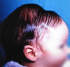 Image result for Cephalhematoma