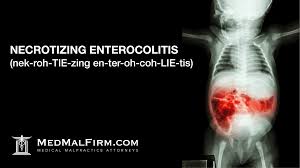 Image result for Necrotizing Enterocolitis