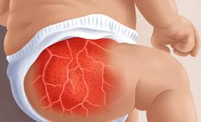 Image result for diaper dermatitis