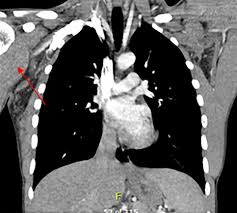 Maybe you would like to learn more about one of these? Necrotizing Myositis Highlighting The Hidden Depths Case Series And Review Of The Literature Khanna 2020 Anz Journal Of Surgery Wiley Online Library