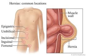 Image result for Inguinal hernia child