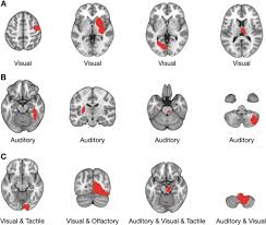 Image result for Neurologic Lesion Localization