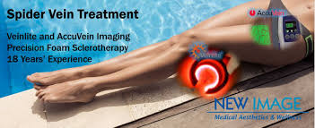 2ml of.25% was used for the procedure. Spider Vein Treatment New Image Medical Aesthetics Wellness