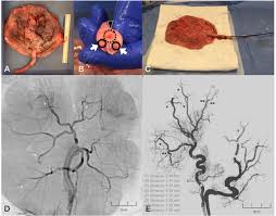 Assessment Of Human Placenta As An Ex Vivo Vascular Model For Testing Of Liquid Embolic Agent Injections With Adjunctive Techniques Journal Of Neurointerventional Surgery The advertised track is a mashup of battle against a true hero from undertale and swept up by lil broomstick. ex vivo vascular model