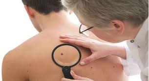 Skin keratosis, also known as seborrheic keratosis, are harmless, noncancerous growths that appear on the face, neck, shoulders. Beware Of The Cancerous Moles On The Skin Here S How To Identify Them