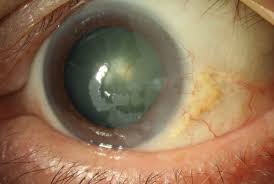 Laser-Assisted Subepithelial Keratectomy (Lasek) Treatment & Management:  Preoperative Details, Intraoperative Details, Postoperative Details