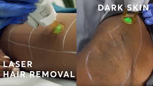 Top 7 laser hair removal devices for dark skin. Laser Hair Removal On Dark Skin Is It Suitable Youtube