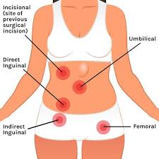 If you noticed a sudden pain in the groin or a sensation as if something had torn a hernia is a weakness or tear in the abdominal muscle wall, which normally holds the inner lining of the. What Is A Hernia How To Tell If You Have A Hernia