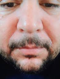 Hi folks, I was told that using moisturizer