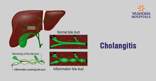 Check spelling or type a new query. How To Treat Biliary Atresia A Rare Digestive Disease In Infants