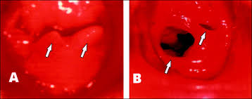 Ruptured hymen which is shamefull inmy society. Sexual Abuse In Children American Academy Of Pediatrics