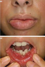 Inflammatory Bowel Disease And Oral Health Bdj Team