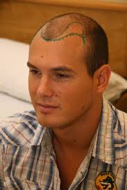 Norbert hosnyánszky, the specialist in backhand shots!! Hosnyanszky Norbert Hajbeultetes Elott Hairhungary Indafoto Hu