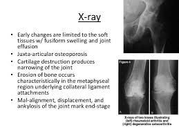 X Ray Rheumatoid Arthritis Vs Osteoarthritis Google Search Rheumatoid Arthritis Vs Osteoarthritis Osteoarthritis Rheumatoid Arthritis