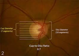 Image result for Eye Examination