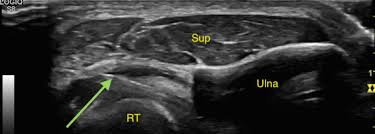 Image result for Biceps Tendon Injection
