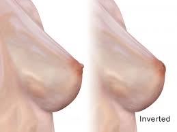 Inverted nipple: Treatment, causes, and pictures