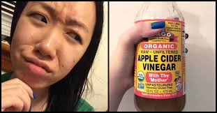 I Tried Apple Cider Vinegar For Acne To See If It Would Work Littlethings Com