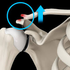 Image result for AC Dislocation