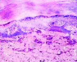 Image result for paronychium