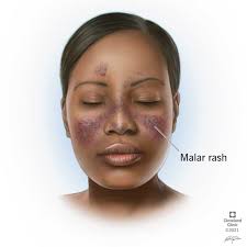 Image result for red rash face