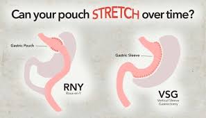 Can You Stretch Your Pouch Tell Me More And What About Pouch Re Sets Bariatric Basics Bariatr Bariatric Surgery Diet Bariatric Surgery Bariatric Sleeve