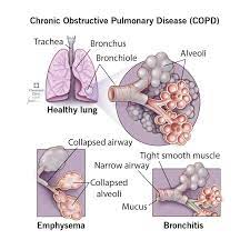 Copd: Causes, Symptoms, Diagnosis, Treatment & Prevention