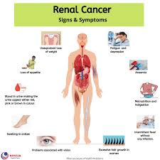Finding cancer early means it's easier to treat. Renal Cancer Signs Symptoms Niruja Healthtech