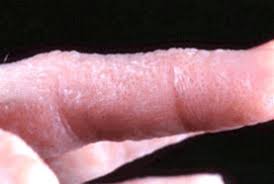 • how often do you get flares of eczema? Overview Of Dermatitis Summary Of Relevant Conditions Bmj Best Practice Us