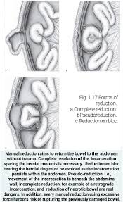 Image result for Hernia Reduction