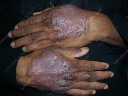 Image result for Lichen Simplex Chronicus