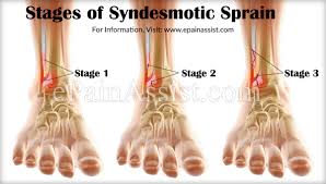 Stages Of Syndesmotic Sprain Or Syndesmotic Ankle Sprain Sas Sprained Ankle Sprain Ankle Sprain Recovery