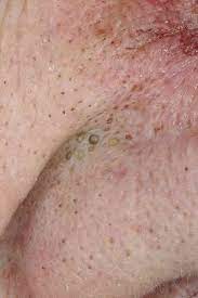 Les points noirs et pores dilatés sont généralement localisés sur la zone t (nez et ailez du nez, menton, front) car c'est là qu'il y a le plus de glandes sébacées. Points Noirs Se Debarrasser Des Points Noirs Sur Le Nez Le Front Teleconsultation Dermatologue