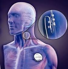 Vagus Nerve Complications Vagus Nerve Epilepsy Stimulation