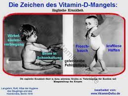 Rachitis Vitamin D Mangel Bei Kindern