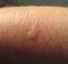 The blisters are a response to seasonal allergies or stress, and can last a few weeks to a moth. Why Do Mosquito Bites Itch Study Com