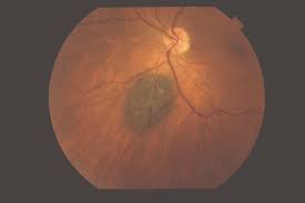 Image result for nevus sclerae