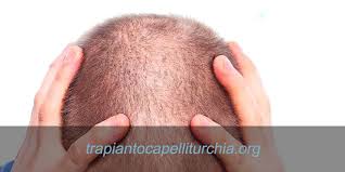 La caduta di capelli, fino a un centinaio al giorno per le chiome più folte, va considerata un normale processo fisiologico di ricambio della capigliatura. Perdita Dei Capelli Se E Temporanea Non Ti Devi Preoccupare Trapianto Capelli Turchia