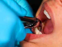 Image result for Tooth Extraction
