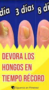 Devora Los Hongos En Tiempo Record Remedios Consejos Remedio Para Hongos Eliminar Hongos De Las Unas Remedios Para Hongos En Los Pies